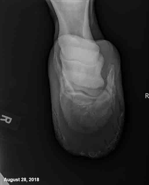 Coffin Bone Fracture Before and After Supplementation – US Case ...